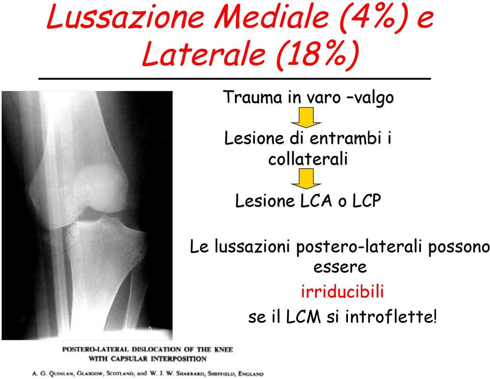 Lesione LCA o LCP Le lussazioni postero-laterali