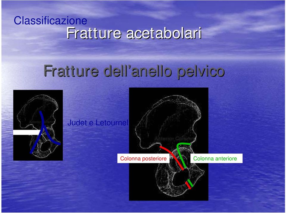 anello pelvico Judet e