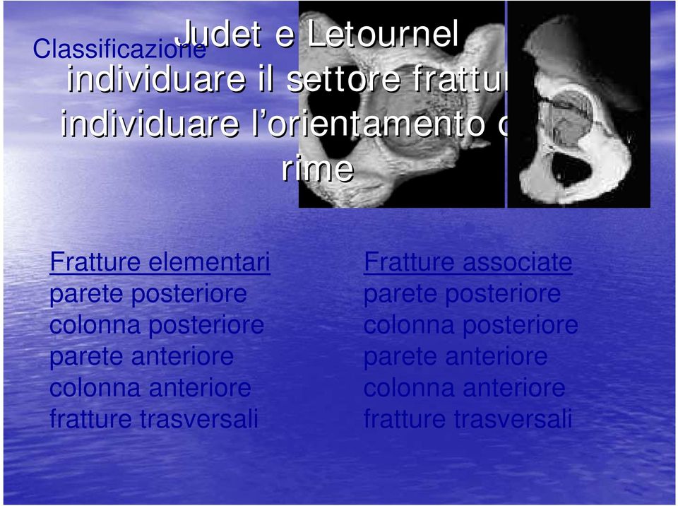 parete anteriore colonna anteriore fratture trasversali Fratture associate parete