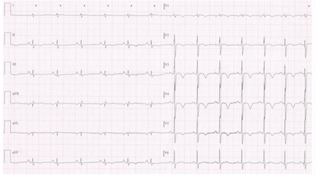 Scenario 3: Un ragazzo di 20 anni presenta il seguente ECG. Domanda #6 (codice domanda: n.376) - (riferita allo scenario n.3) : Cosa si nota all'ecg?