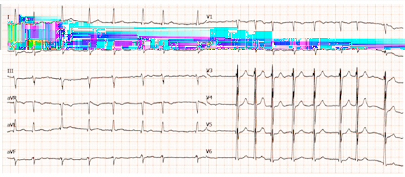 Scenario 4: Una paziente di 45 anni viene ricoverata per shock cardiogeno e si pone il sospetto di miocardite. Domanda #8 (codice domanda: n.378) - (riferita allo scenario n.
