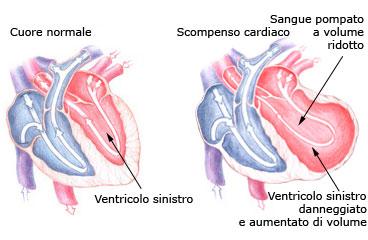 VALUTAZIONE DELLO SCOMPENSO CARDIACO lo scompenso cardiaco (insufficienza cardiaca)