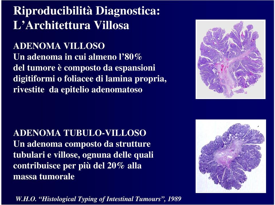 adenomatoso ADENOMA TUBULO-VILLOSO Un adenoma composto da strutture tubulari e villose, ognuna delle