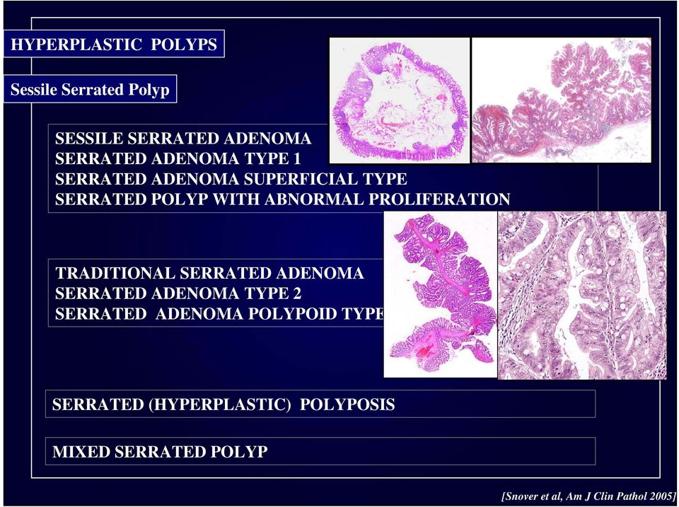 TRADITIONAL SERRATED ADENOMA SERRATED ADENOMA TYPE 2 SERRATED ADENOMA POLYPOID TYPE