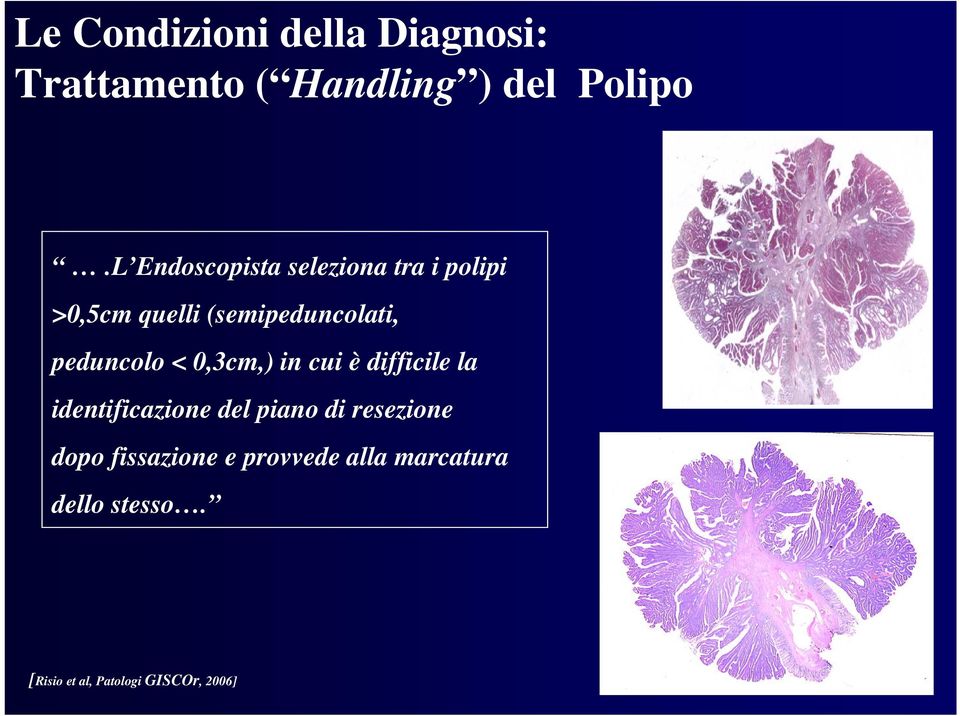 peduncolo < 0,3cm,) in cui è difficile la identificazione del piano di