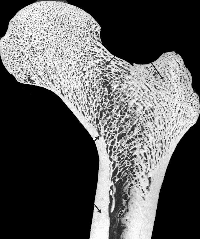 osso spugnoso l osso spugnoso è costituito da sottili trabecole o spicole