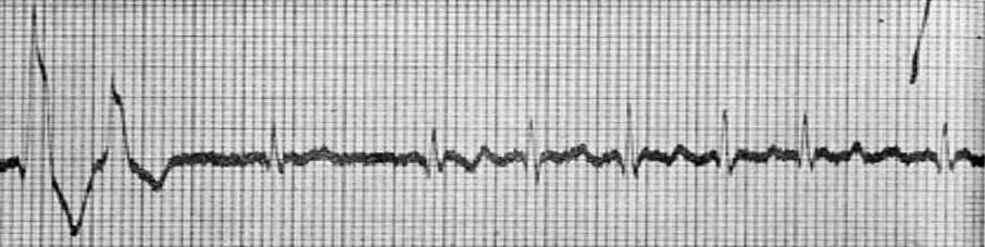 Elettrocardiogramma Pulsus Inaequalis et Irregularis Einthoven W.