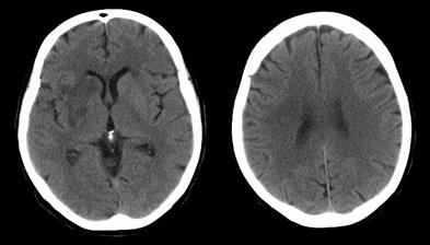 ASPECTS Per calcolare l estensione dell infarto si usa il punteggio ASPECTS (Alberta Stroke Program Early CT Score): si suddivide il territorio dell arteria cerebrale media in