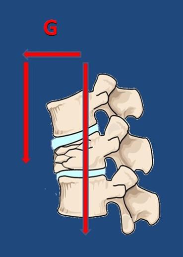 Patogenesi delle FV Il centro di gravità si sposta in avanti La parte anteriore deve sopportate un carico maggiore che in un osso fragile determina la