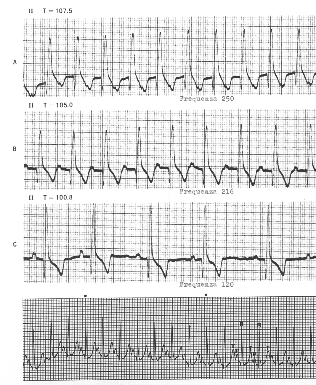 TS in un cane con febbre: notare le P inscritte nelle T a freq. 250, quando la T scende, la freq.