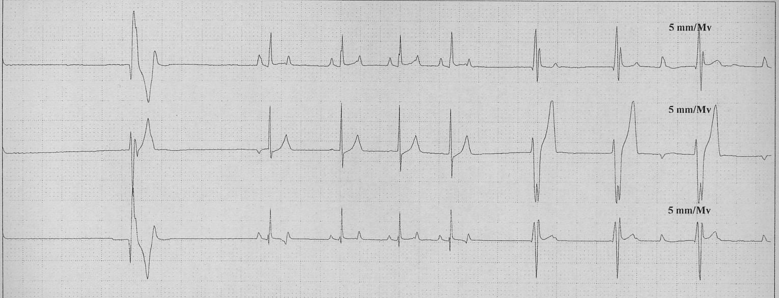 ARITMIE CARDIACHE