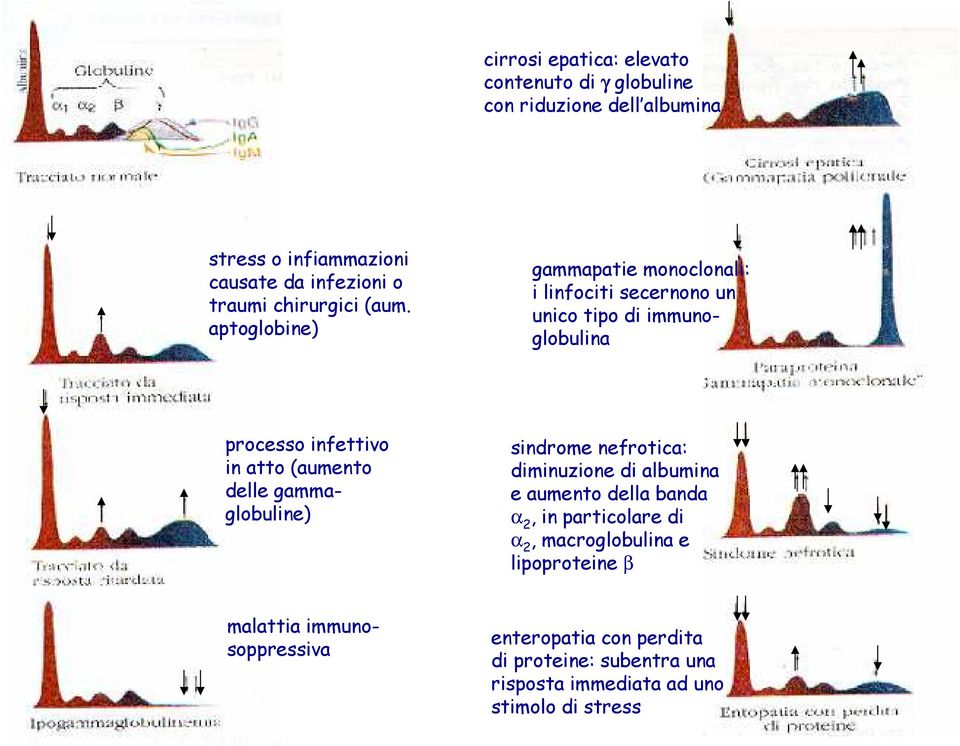 aptoglobine) gammapatie monoclonali: i linfociti secernono un unico tipo di immunoglobulina processo infettivo in atto (aumento delle