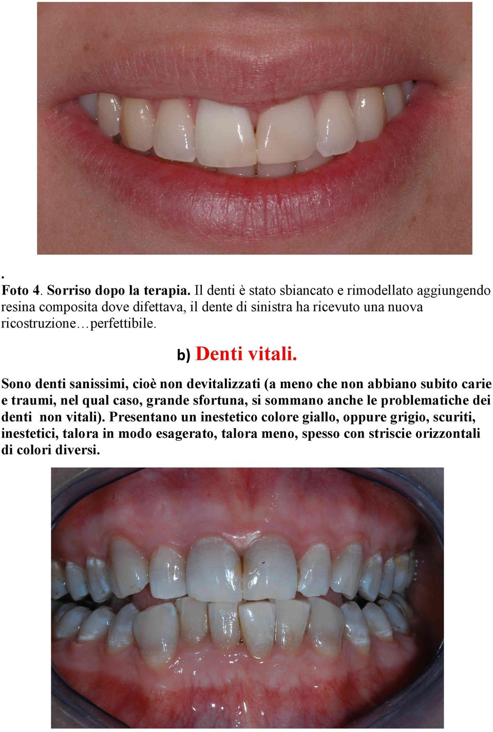 ricostruzione perfettibile. b) Denti vitali.