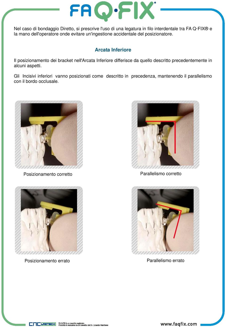 Arcata Inferiore Il posizionamento dei bracket nell'arcata Inferiore differisce da quello descritto precedentemente in alcuni
