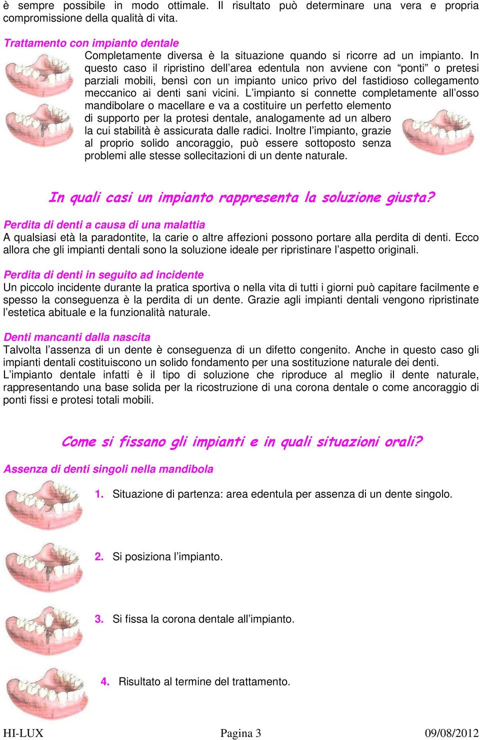 In questo caso il ripristino dell area edentula non avviene con ponti o pretesi parziali mobili, bensì con un impianto unico privo del fastidioso collegamento meccanico ai denti sani vicini.