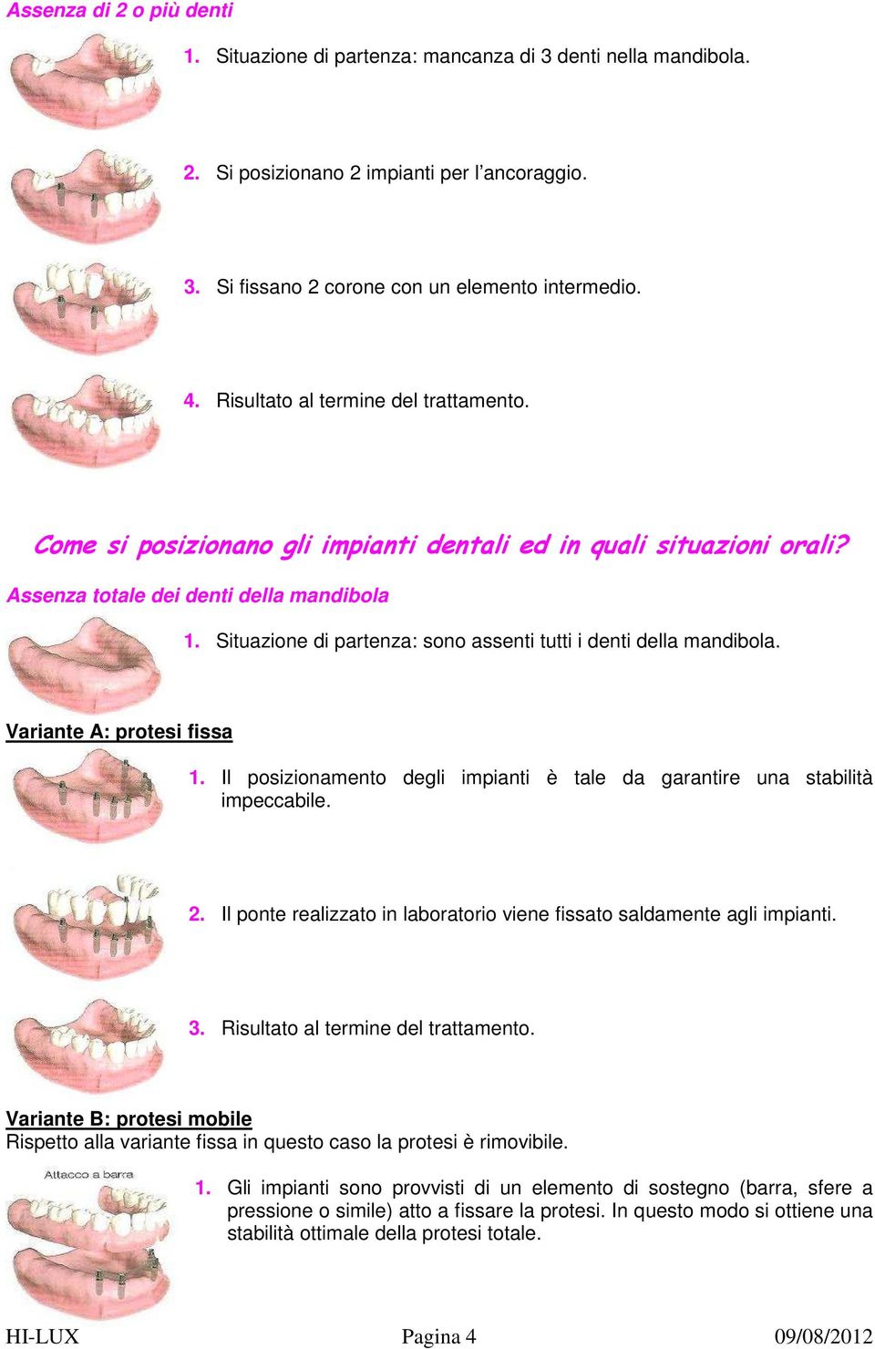 Situazione di partenza: sono assenti tutti i denti della mandibola. Variante A: protesi fissa 1. Il posizionamento degli impianti è tale da garantire una stabilità impeccabile. 2.