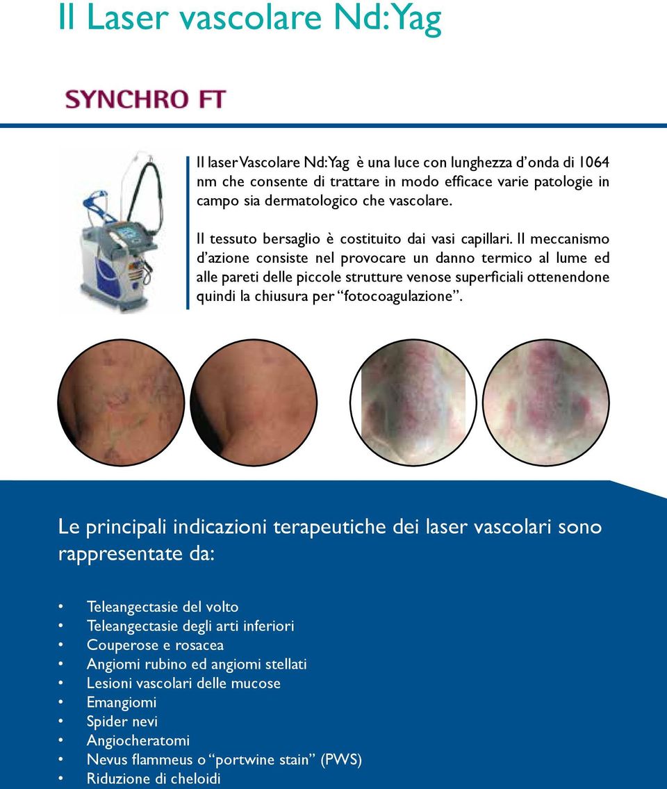Il meccanismo d azione consiste nel provocare un danno termico al lume ed alle pareti delle piccole strutture venose superficiali ottenendone quindi la chiusura per fotocoagulazione.