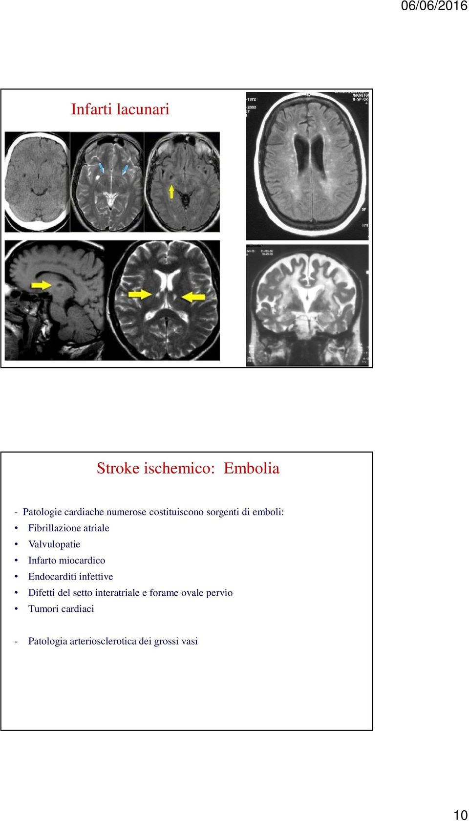 Infarto miocardico Endocarditi infettive Difetti del setto interatriale e