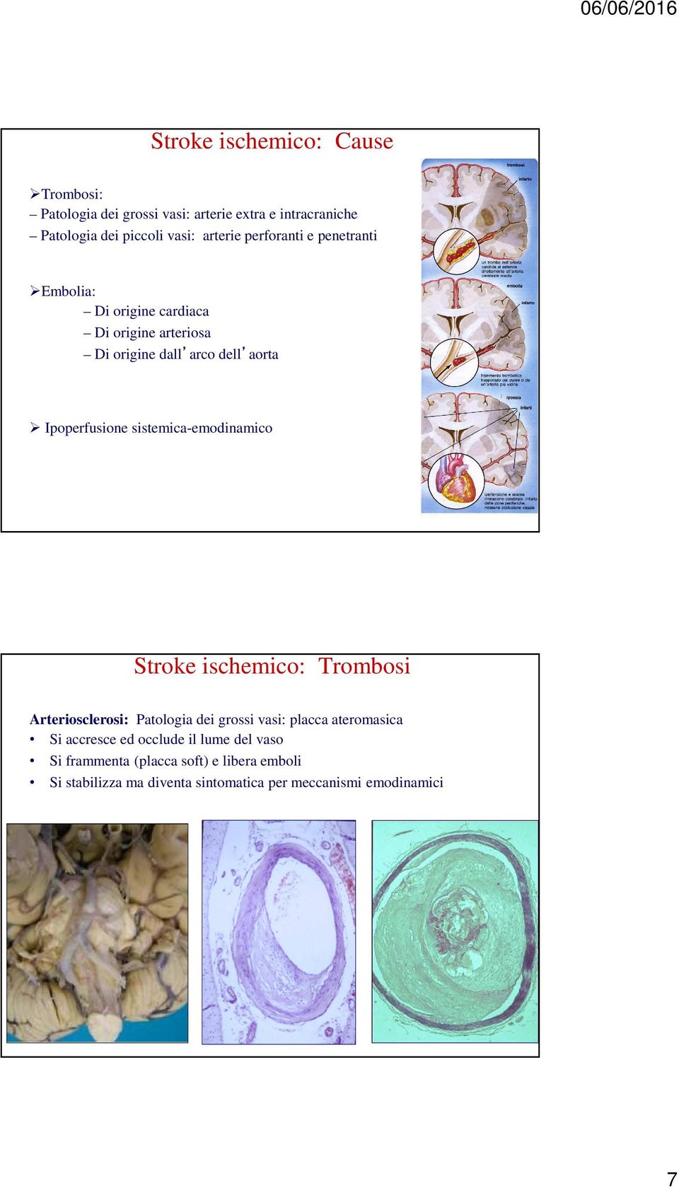 sistemica-emodinamico Stroke ischemico: Trombosi Arteriosclerosi: Patologia dei grossi vasi: placca ateromasica Si accresce ed