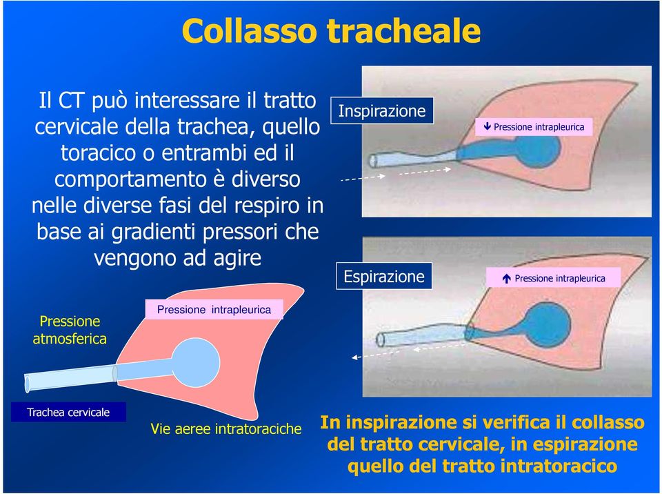 Espirazione Pressione intrapleurica Pressione intrapleurica Pressione atmosferica Pressione intrapleurica Trachea