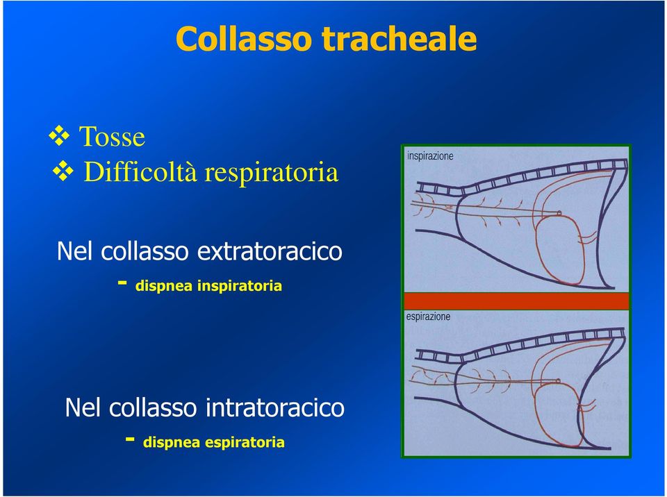 extratoracico - dispnea inspiratoria