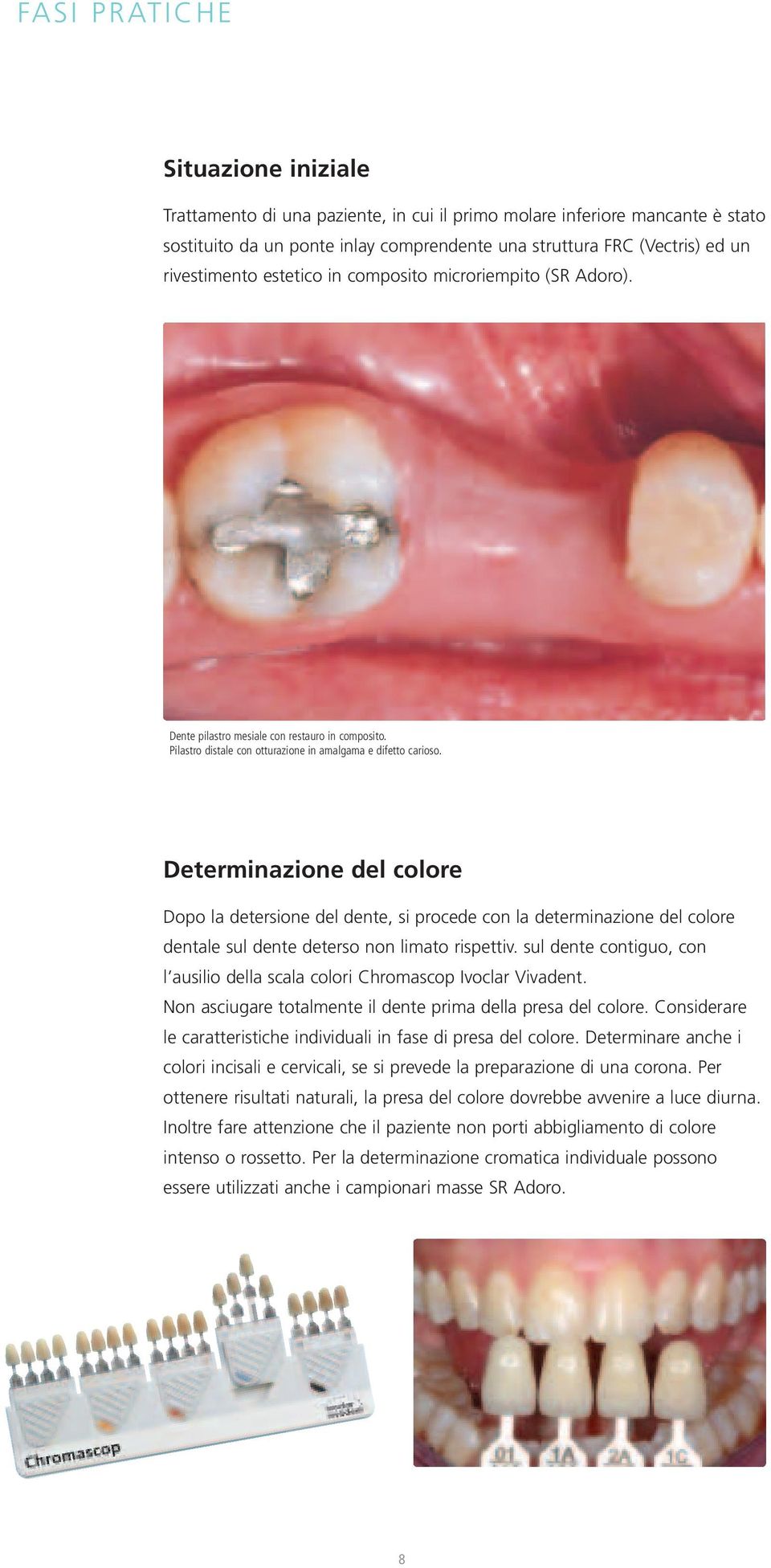 Determinazione del colore Dopo la detersione del dente, si procede con la determinazione del colore dentale sul dente deterso non limato rispettiv.