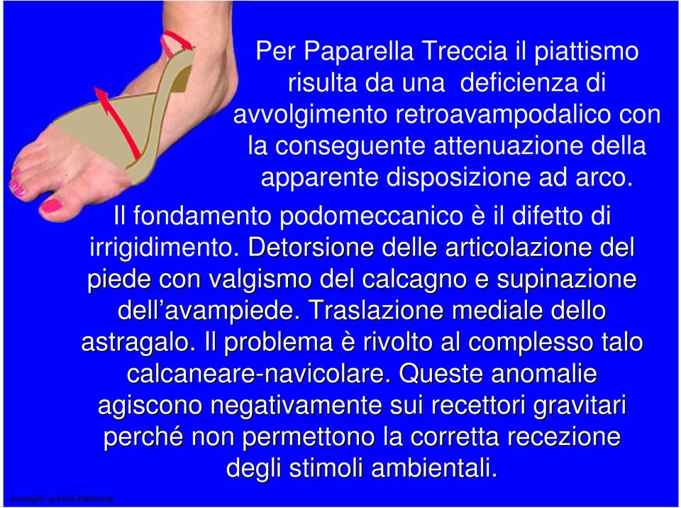 Detorsione delle articolazione del piede con valgismo del calcagno e supinazione dell avampiede avampiede.. Traslazione mediale dello astragalo.