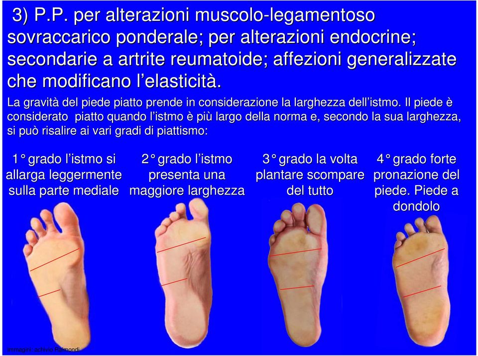 Il piede è considerato piatto quando l istmo l è più largo della norma e, secondo la sua larghezza, si può risalire ai vari gradi di piattismo: 1 grado l istmo l si