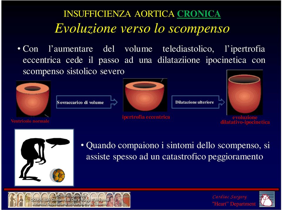 ovraccarico di volume Dilatazione ulteriore Ventricolo normale ipertrofia eccentrica evoluzione