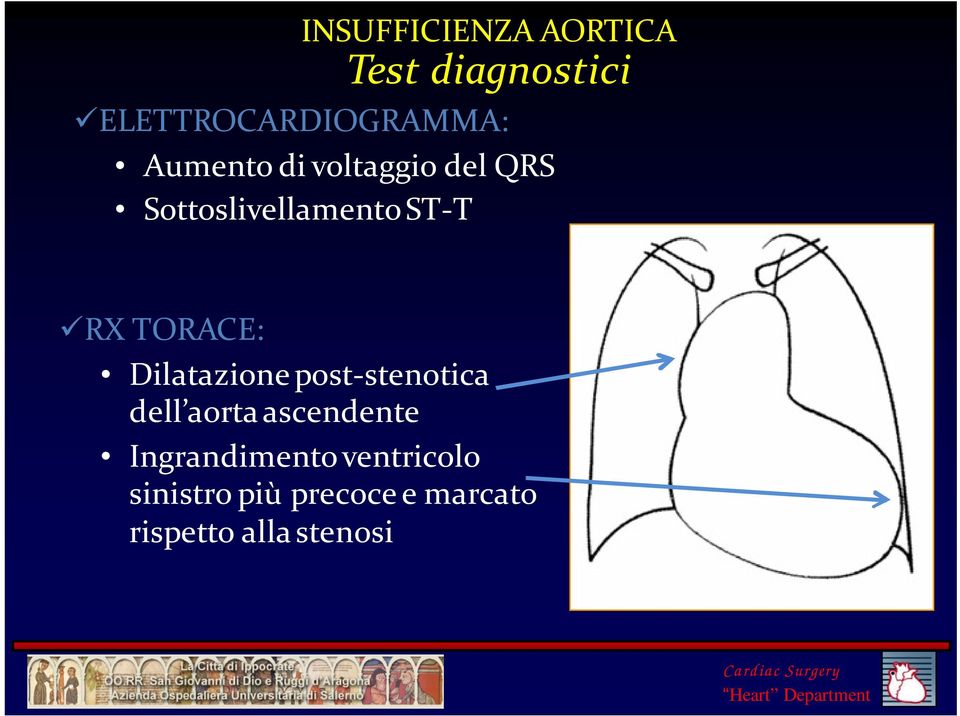 TORACE: Dilatazione post-stenotica dell aorta ascendente