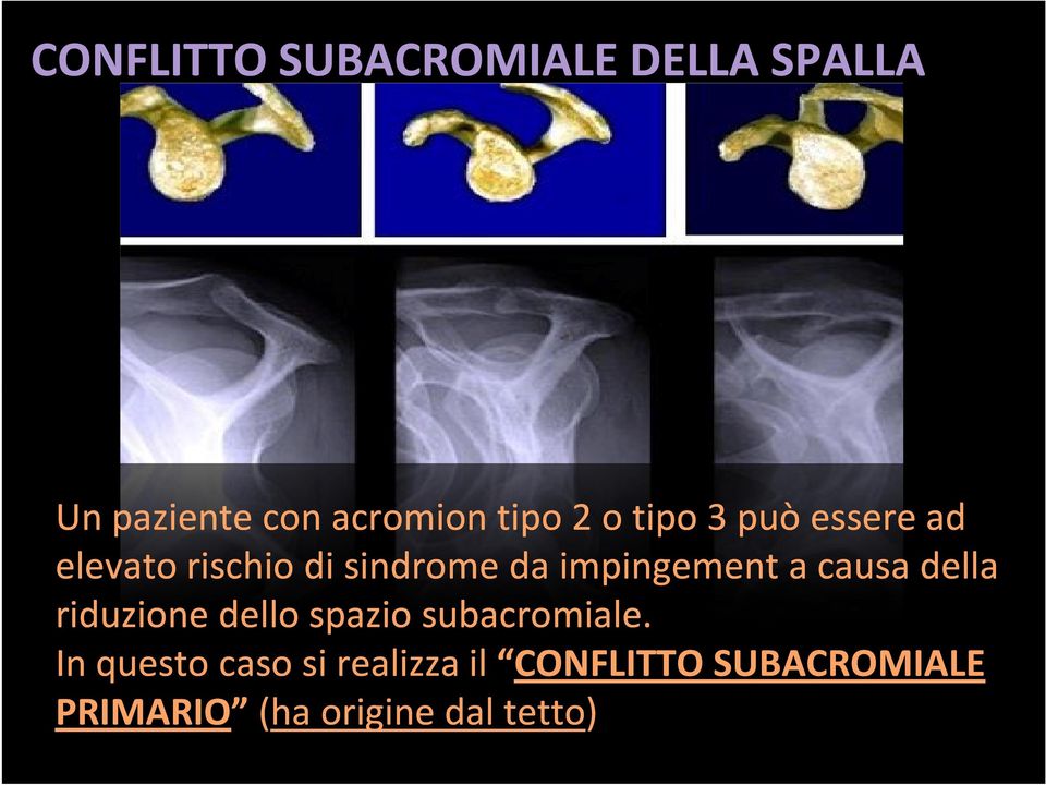 riduzione dello spazio subacromiale.