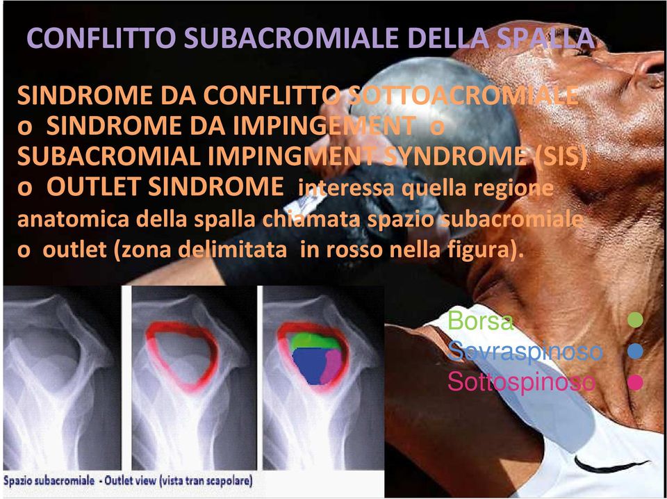 quellaregione anatomica della spalla chiamata spazio subacromiale o