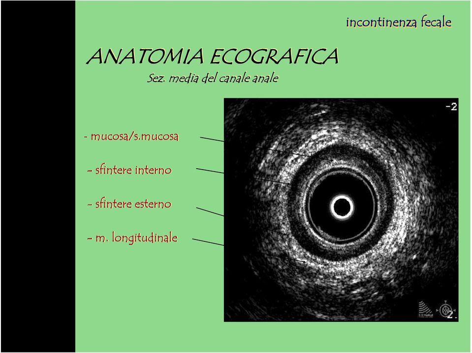 incontinenza fecale - mucosa/s.