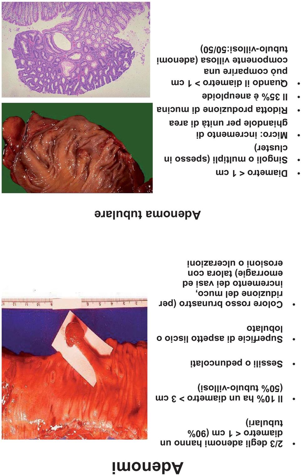 erosioni o ulcerazioni Adenomi Adenoma tubulare Diametro < 1 cm Singoli o multipli (spesso in cluster) Micro: incremento di ghiandole per