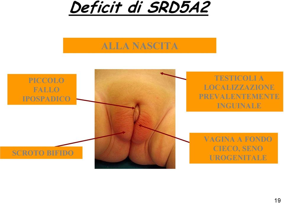 LOCALIZZAZIONE PREVALENTEMENTE INGUINALE