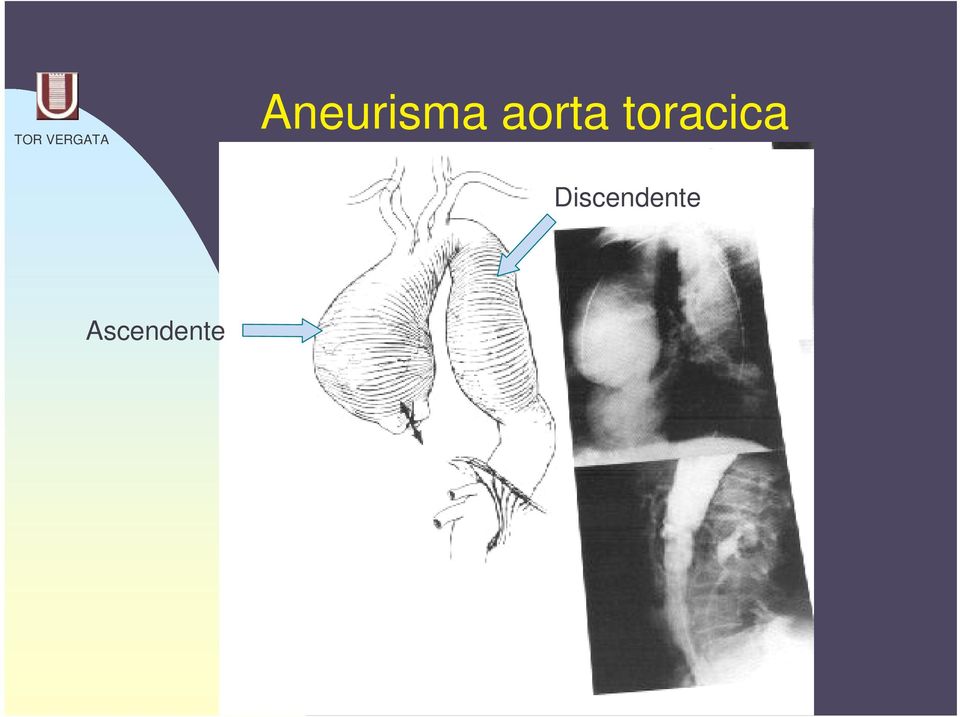 toracica