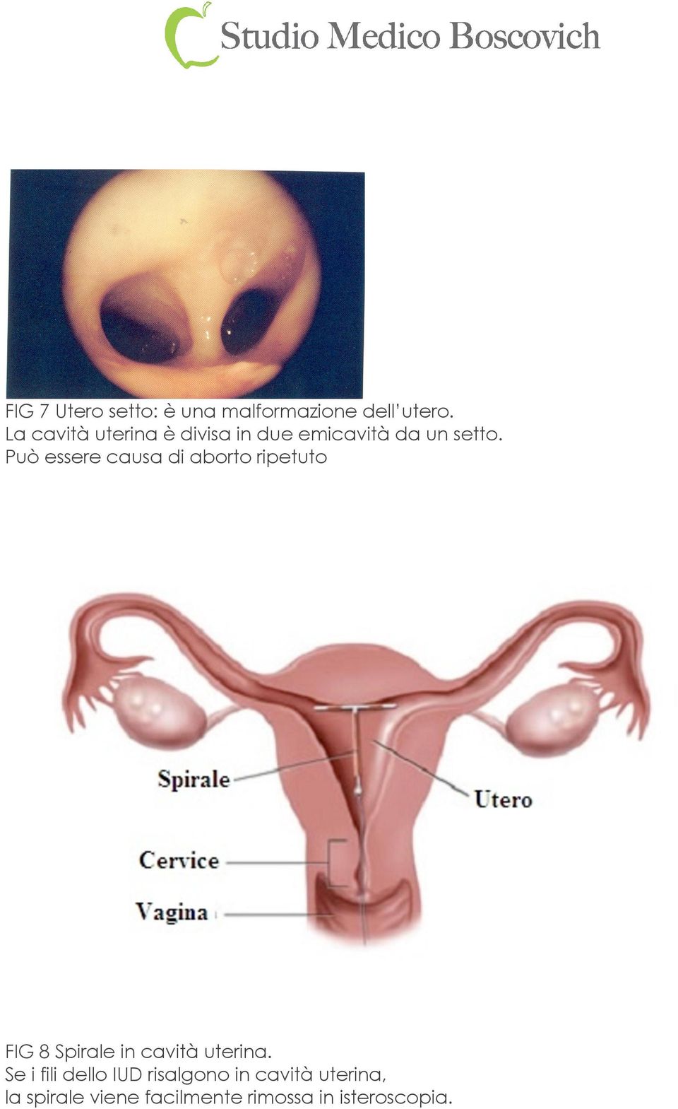 Può essere causa di aborto ripetuto FIG 8 Spirale in cavità uterina.