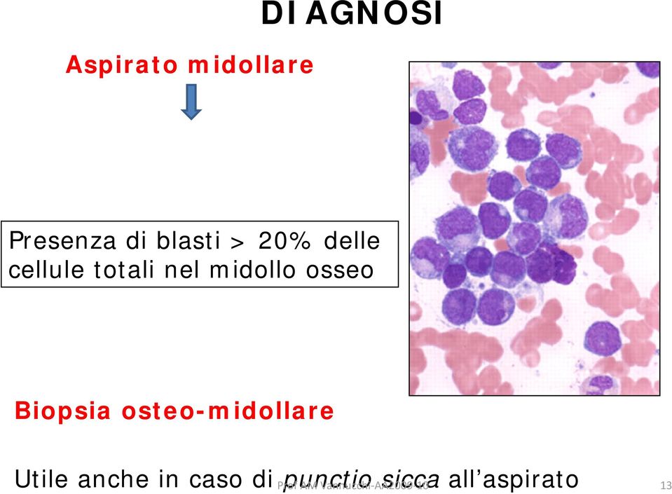 Biopsia osteo-midollare Utile anche in caso di