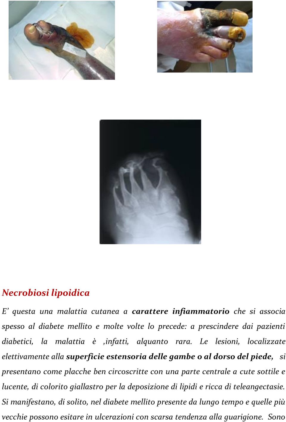 Le lesioni, localizzate elettivamente alla superficie estensoria delle gambe o al dorso del piede, si presentano come placche ben circoscritte con una parte
