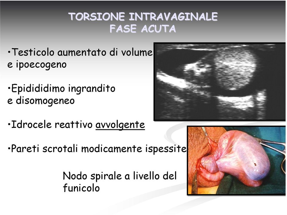 disomogeneo Idrocele reattivo avvolgente Pareti