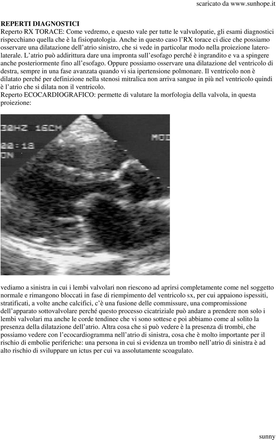 L atrio può addirittura dare una impronta sull esofago perché è ingrandito e va a spingere anche posteriormente fino all esofago.