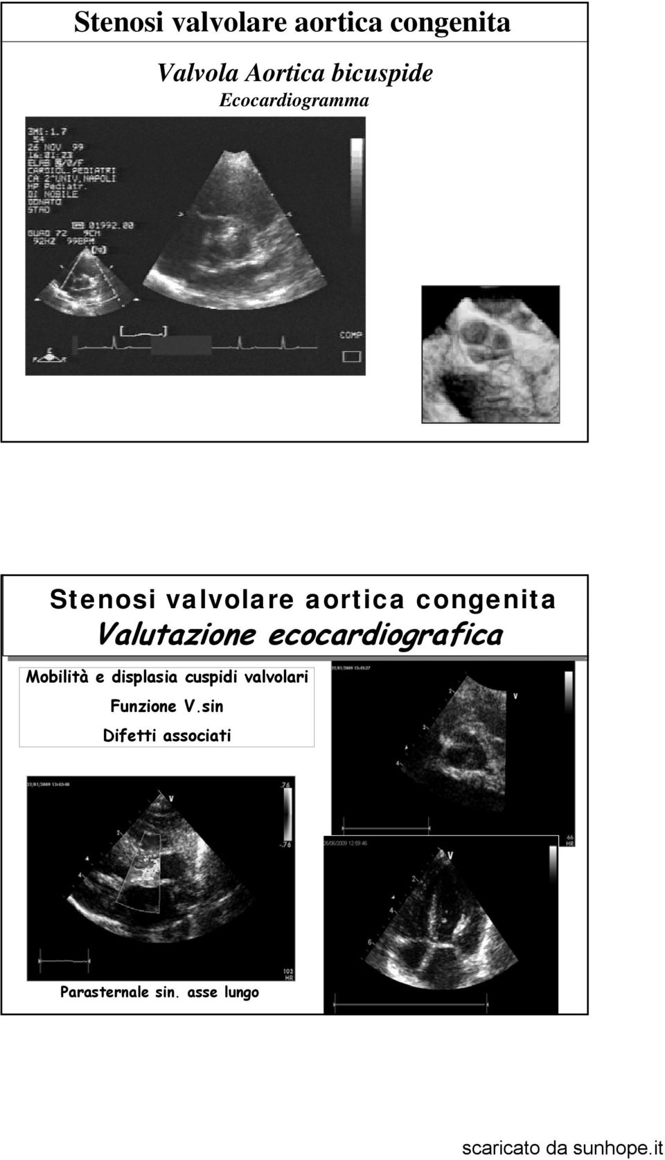 congenita Valutazione ecocardiografica Mobilità e displasia