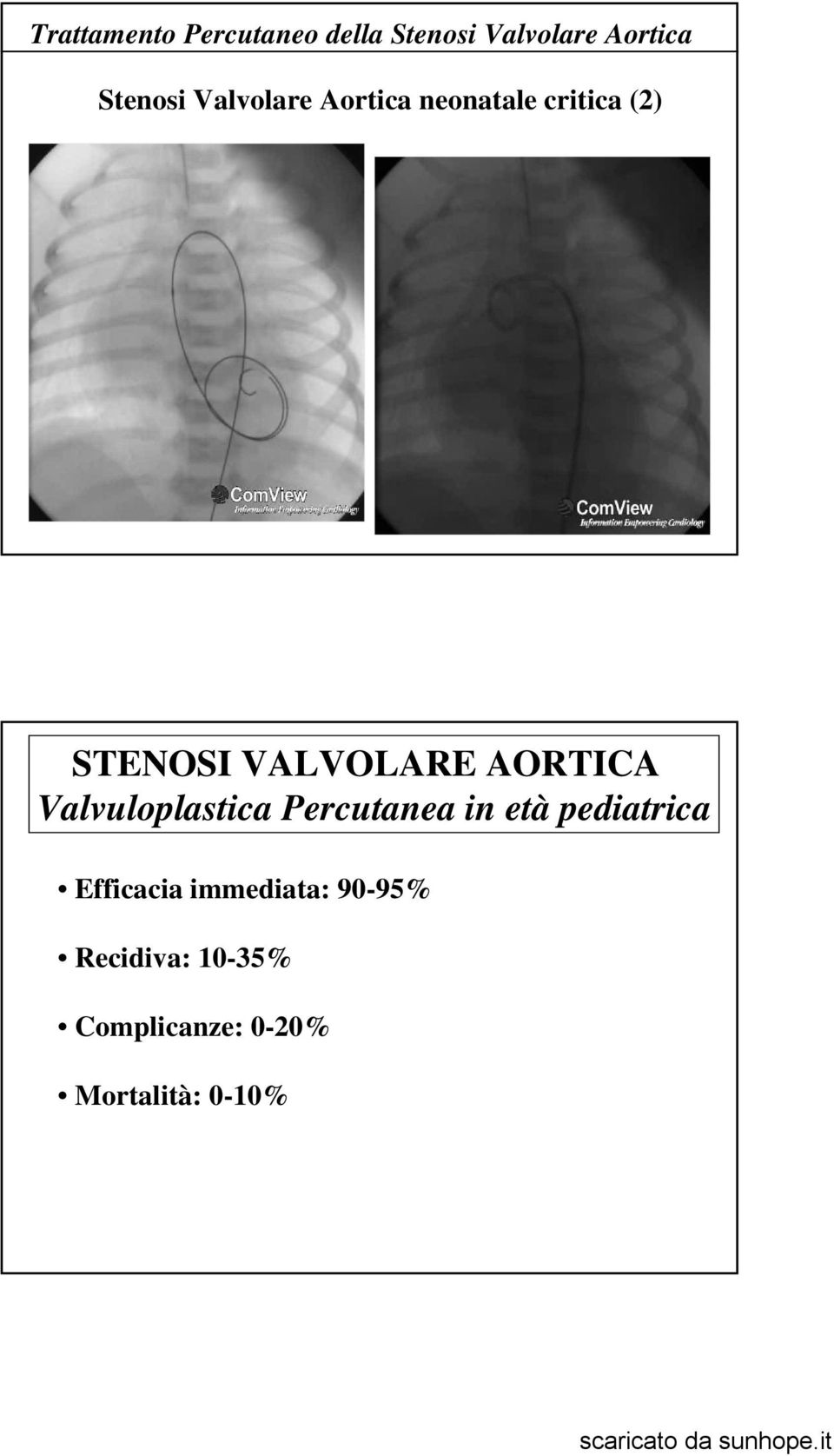 AORTICA Valvuloplastica Percutanea in età pediatrica Efficacia