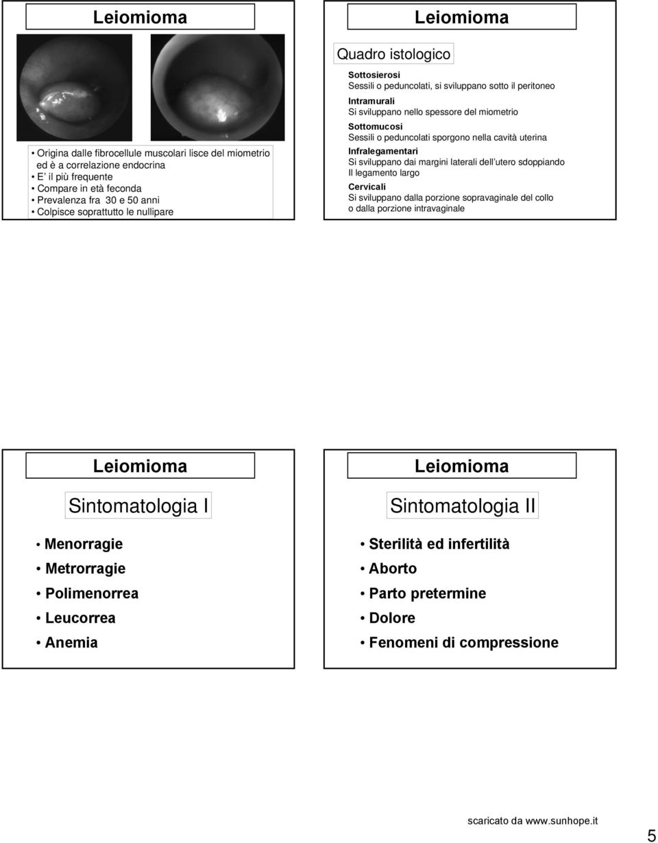 sporgono nella cavità uterina Infralegamentari Si sviluppano dai margini laterali dell utero sdoppiando Il legamento largo Cervicali Si sviluppano dalla porzione sopravaginale del collo o dalla