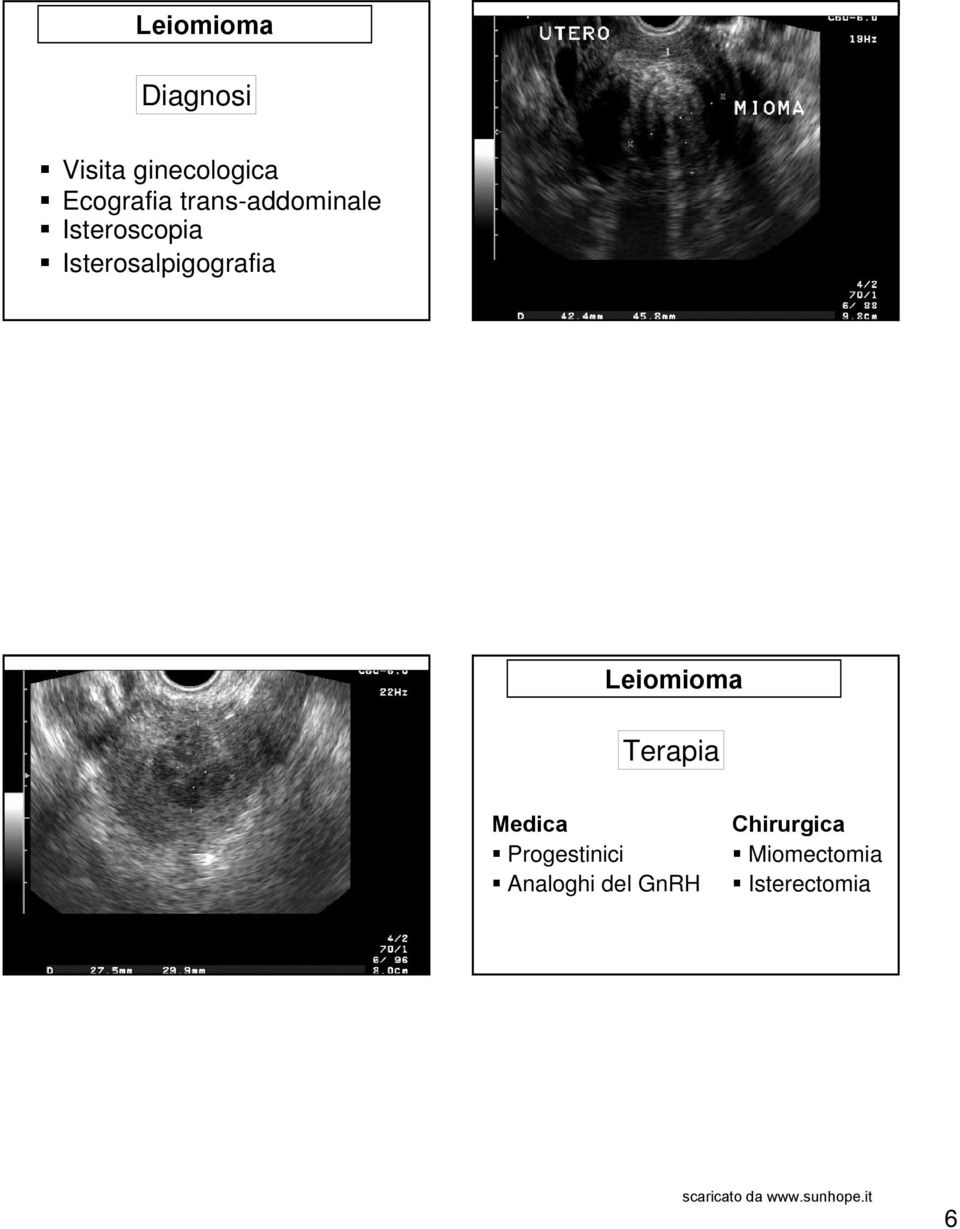 Isterosalpigografia Leiomioma Terapia Medica