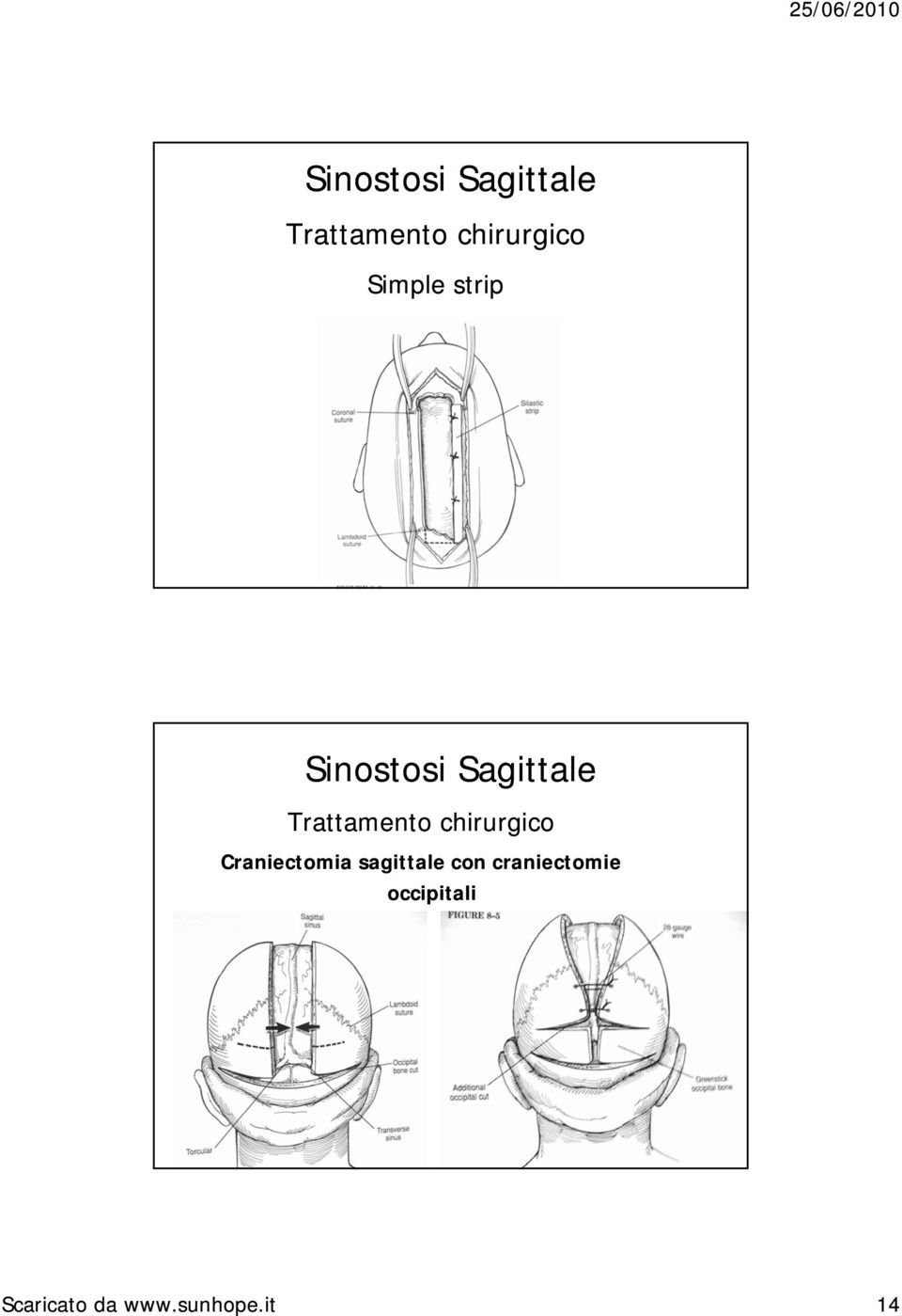 sagittale con craniectomie