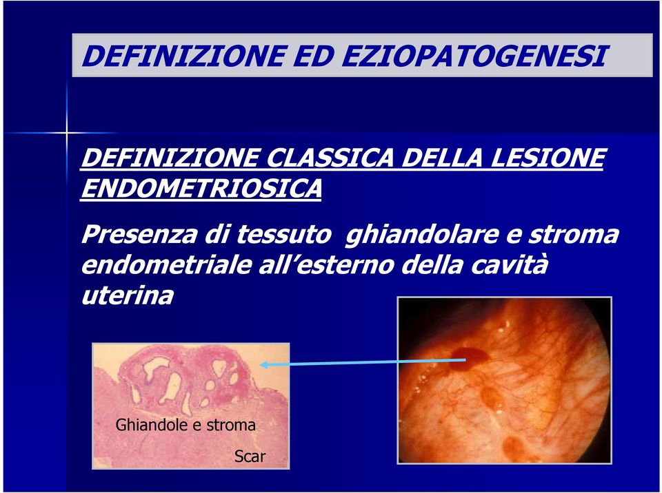 di tessuto ghiandolare e stroma endometriale