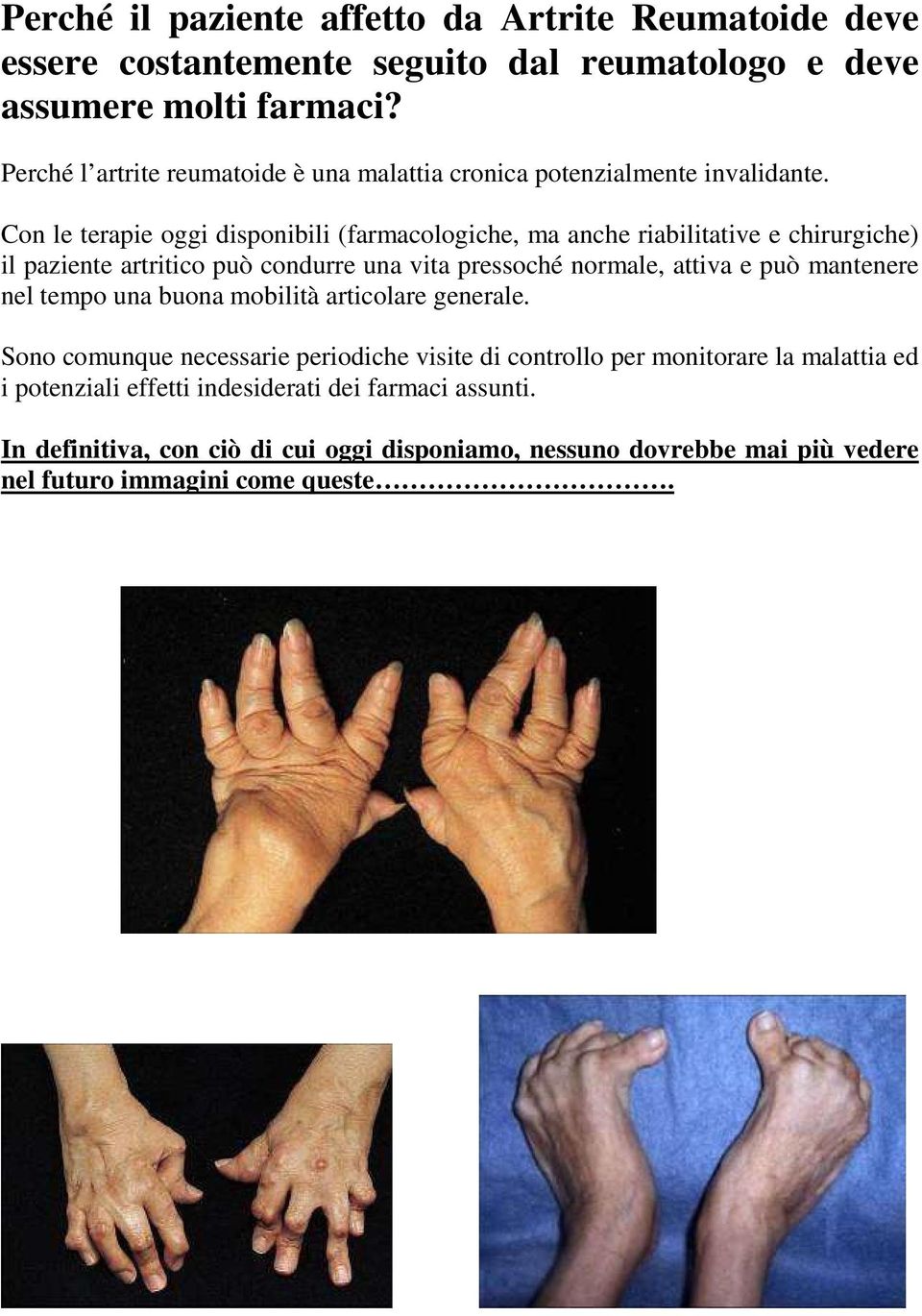 Con le terapie oggi disponibili (farmacologiche, ma anche riabilitative e chirurgiche) il paziente artritico può condurre una vita pressoché normale, attiva e può