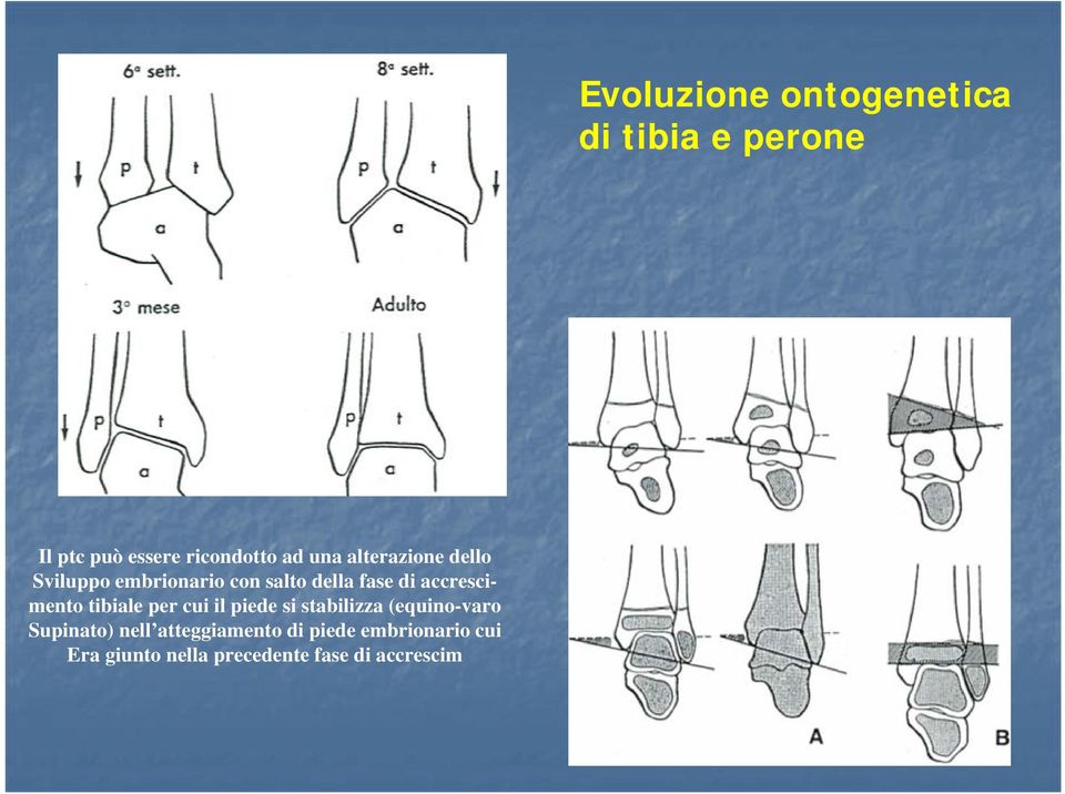 (equino-varo Supinato) nell atteggiamento di piede embrionario cui Era