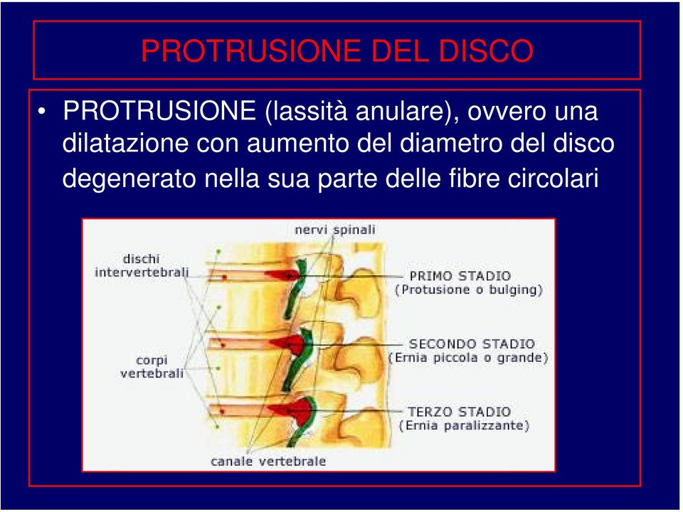 dilatazione con aumento del diametro